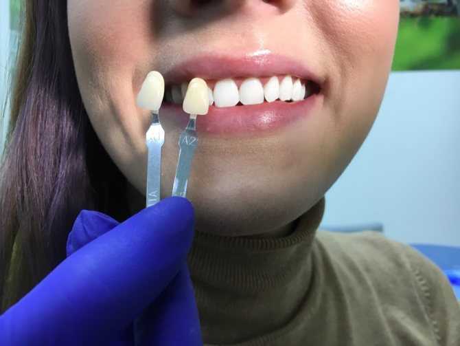 Какое отбеливание зубов безопаснее
