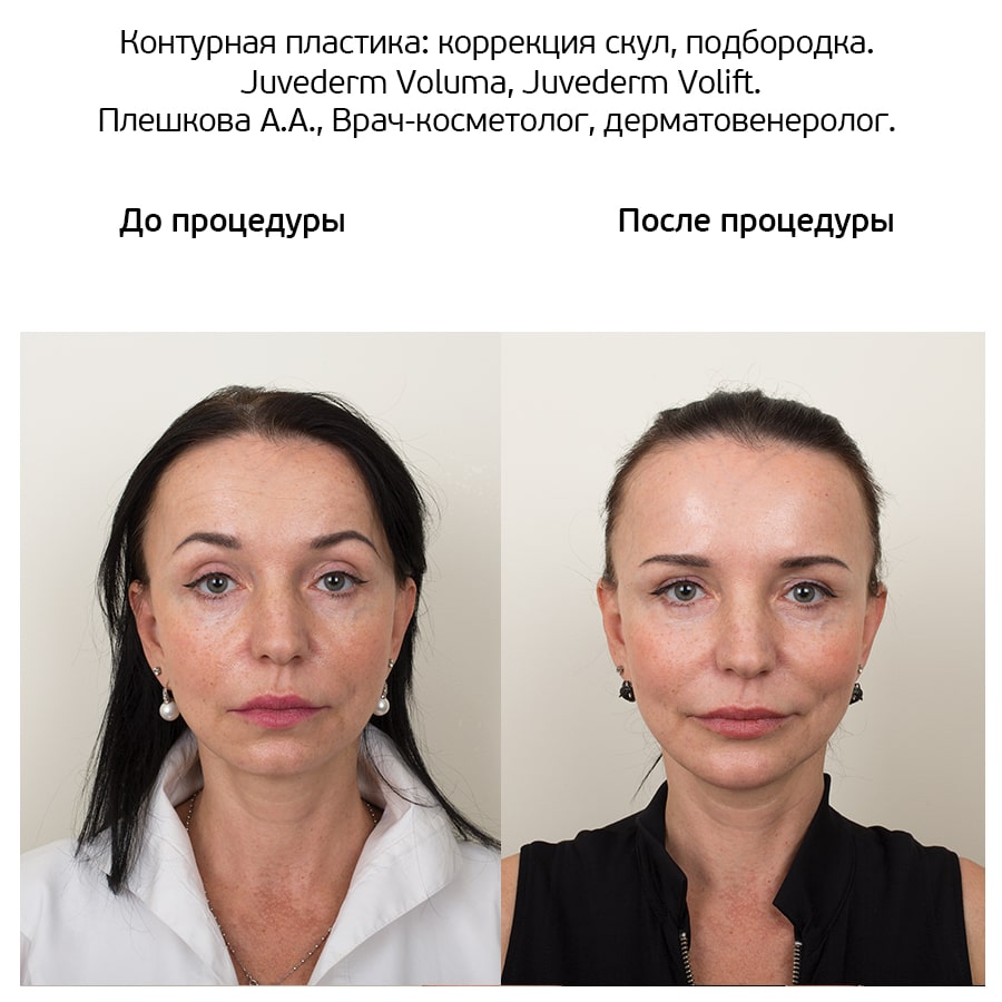 Ботокс и филлеры – что нужно учитывать, прежде чем пойти на процедуры — центр эстетической медицины