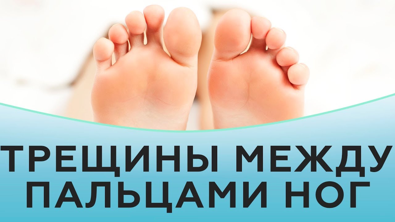 Самые распространенные причины трещин между пальцами ног на ногах Как лечить аптечными средствами и народными методами Основные меры профилактики
