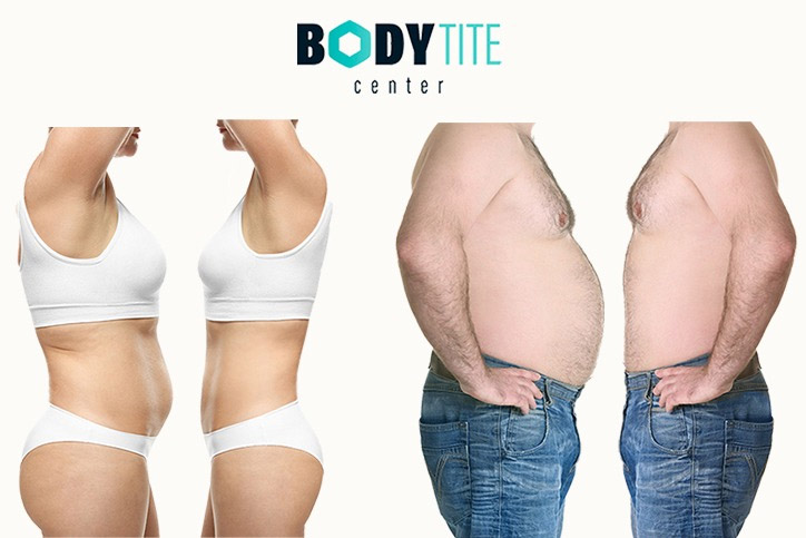 Радиочастотная липосакция body tite (rf-липосакция). акция!