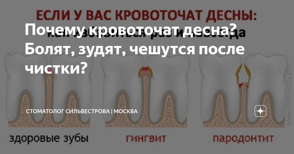 Кровоточивость десен: причины, лечение