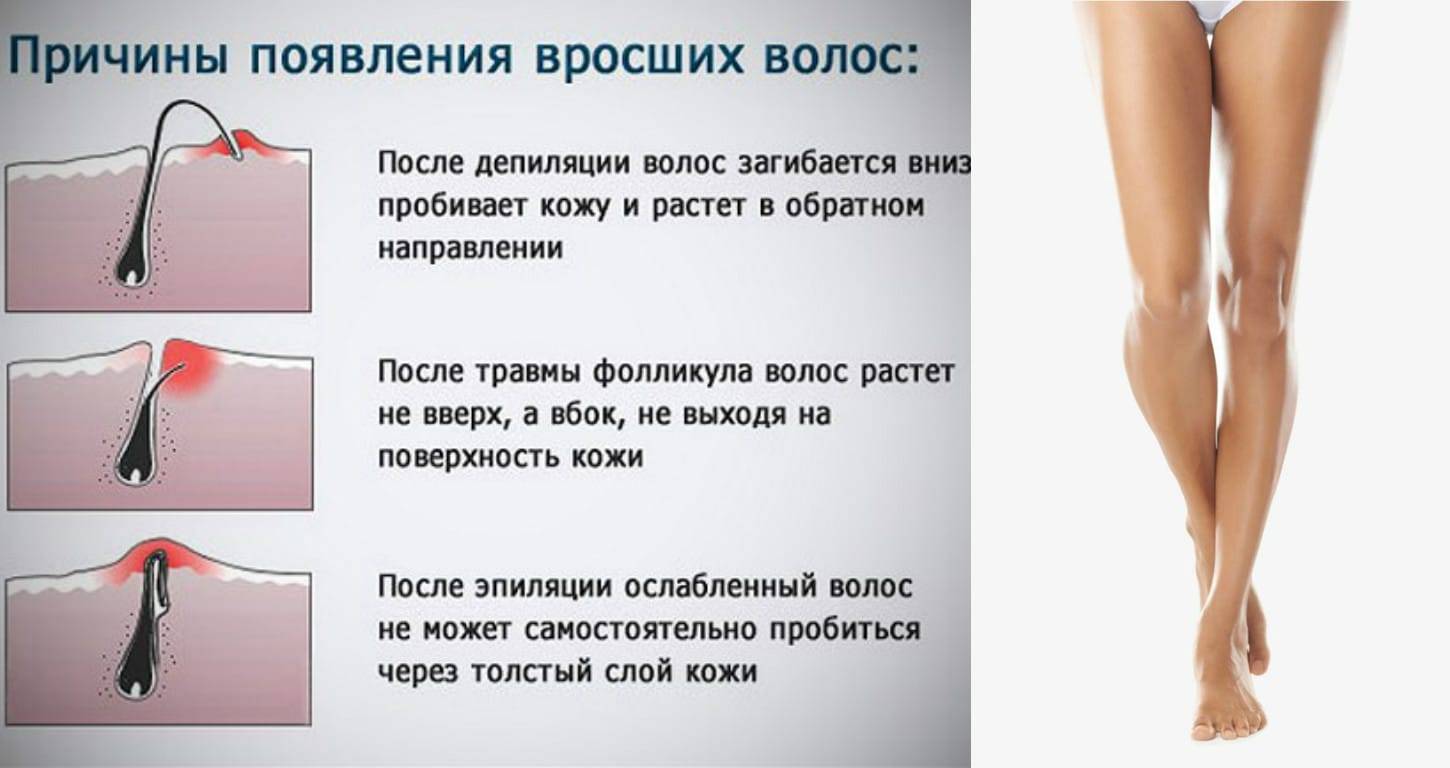 Как снять раздражение после эпиляции воском?