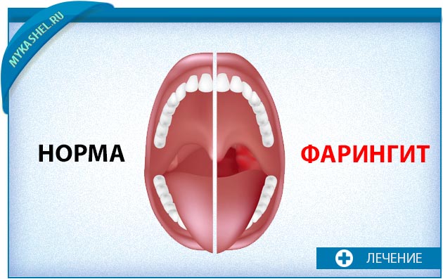 Как лечить фарингит народными средствами