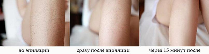 Уход за сухой кожей после депиляции, эпиляции
