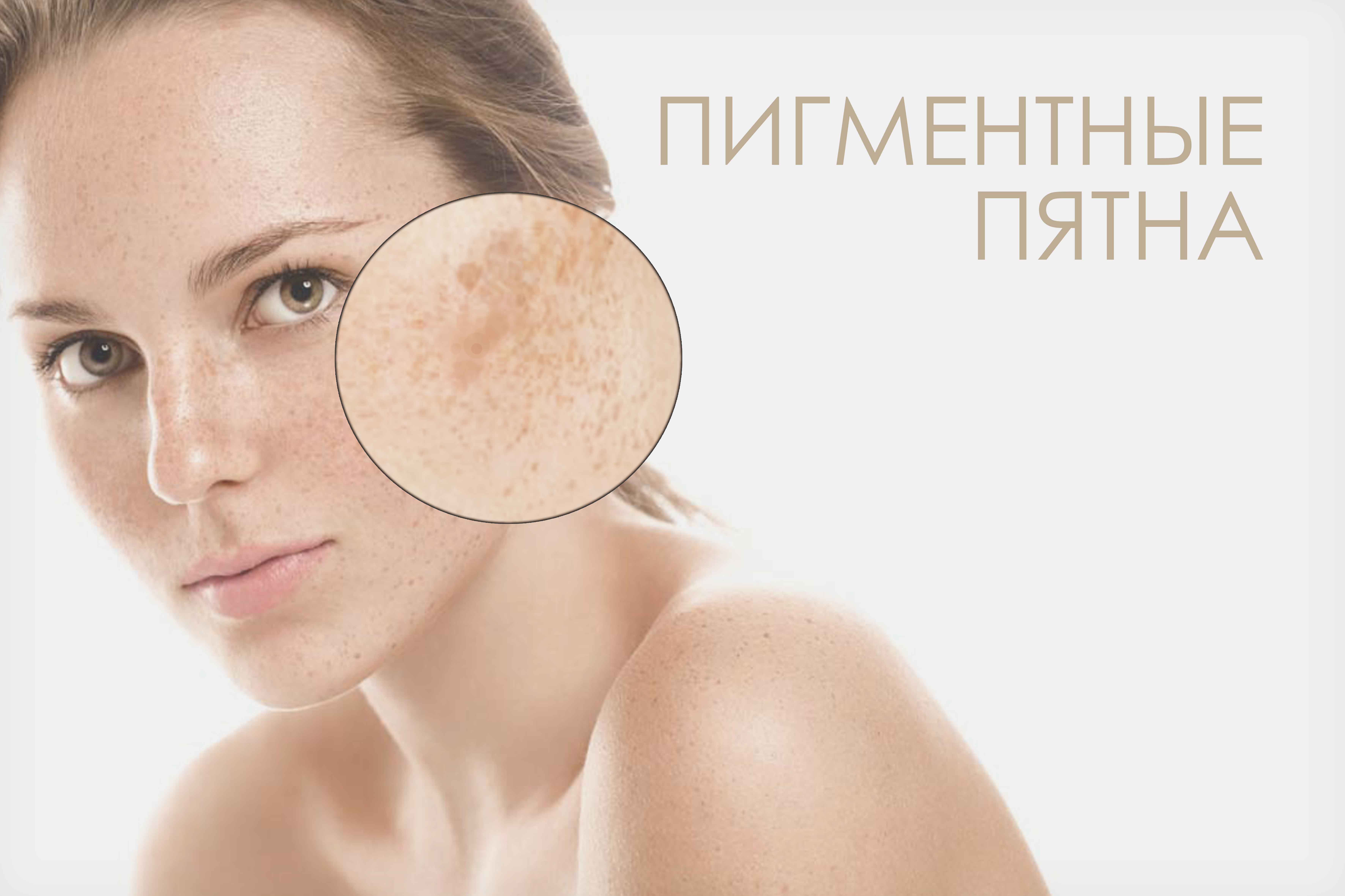 Мелазма на лице: что это такое и как ее лечить в домашних условия?