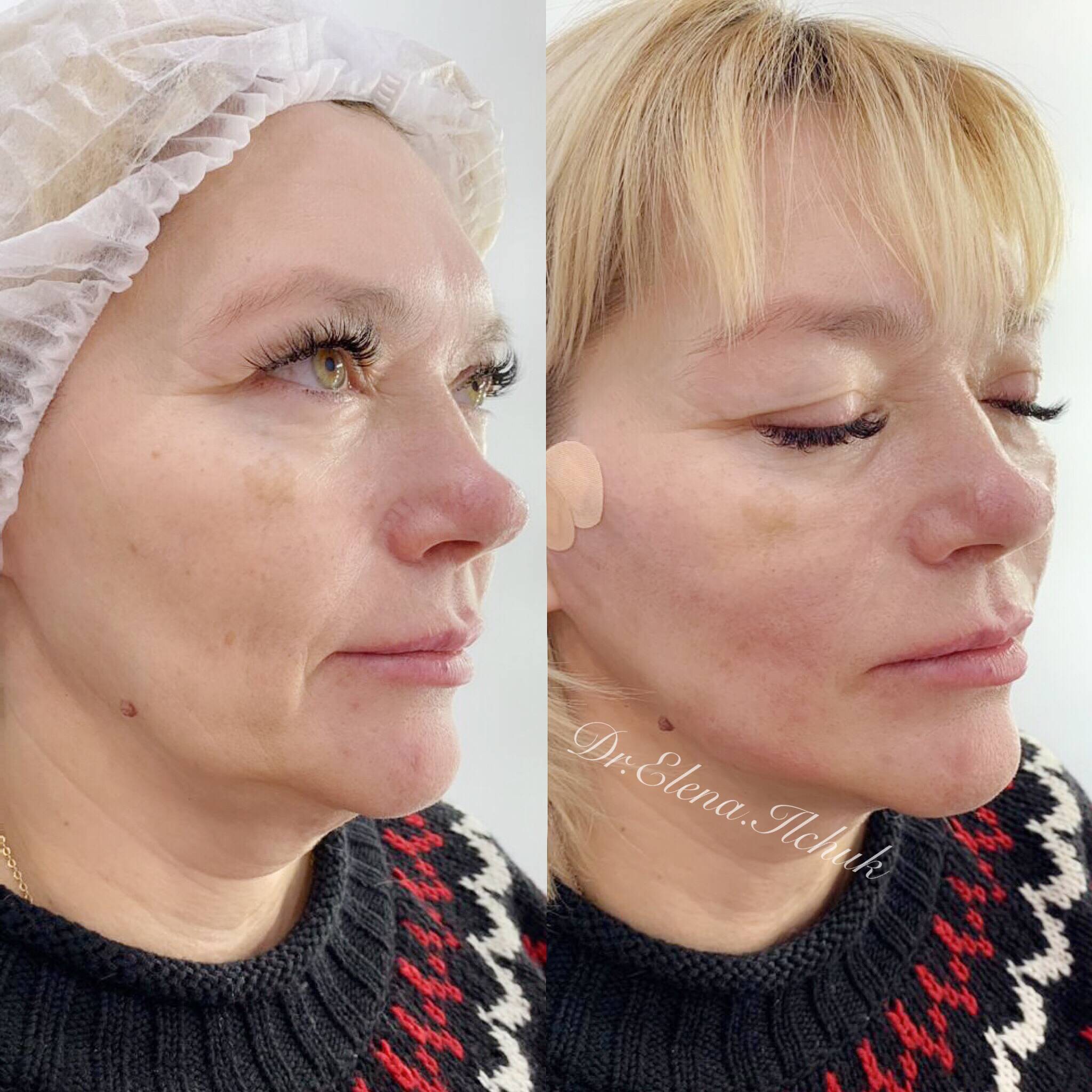 Современный подход к моделированию лица: нити aptos excellence visage | александр катков