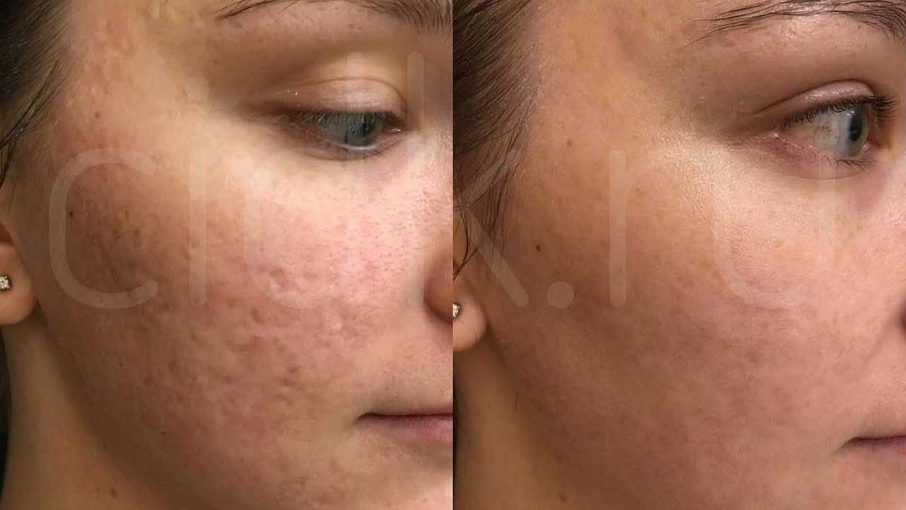 Picosure laser review (before & after photos) - organic beauty lover
picosure laser review (before & after photos) - organic beauty lover