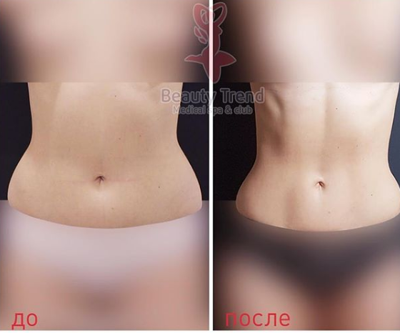 Радиочастотная липосакция body tite – клиника эстетической медицины клазко