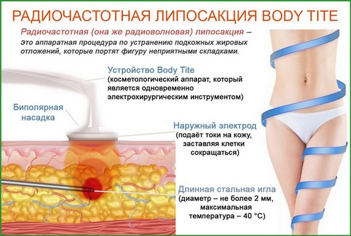 Безопасна ли радиочастотная подтяжка молочных желез И почему того же эффекта нельзя добиться другими хирургическими методами – отвечает хирург и онколог Вардан Аршакян