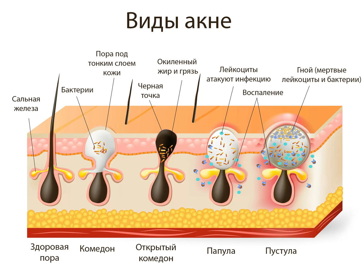 О чем говорят прыщи, и как с ними бороться?