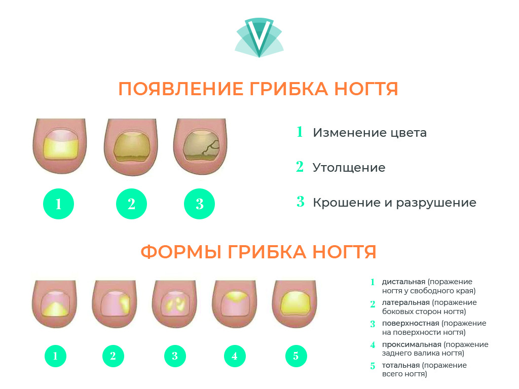 Лечение грибка ногтей: методы, особенности, описание процедуры и последствий