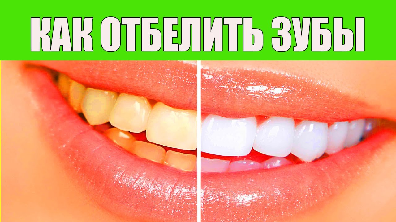 Как отбелить зубы содой