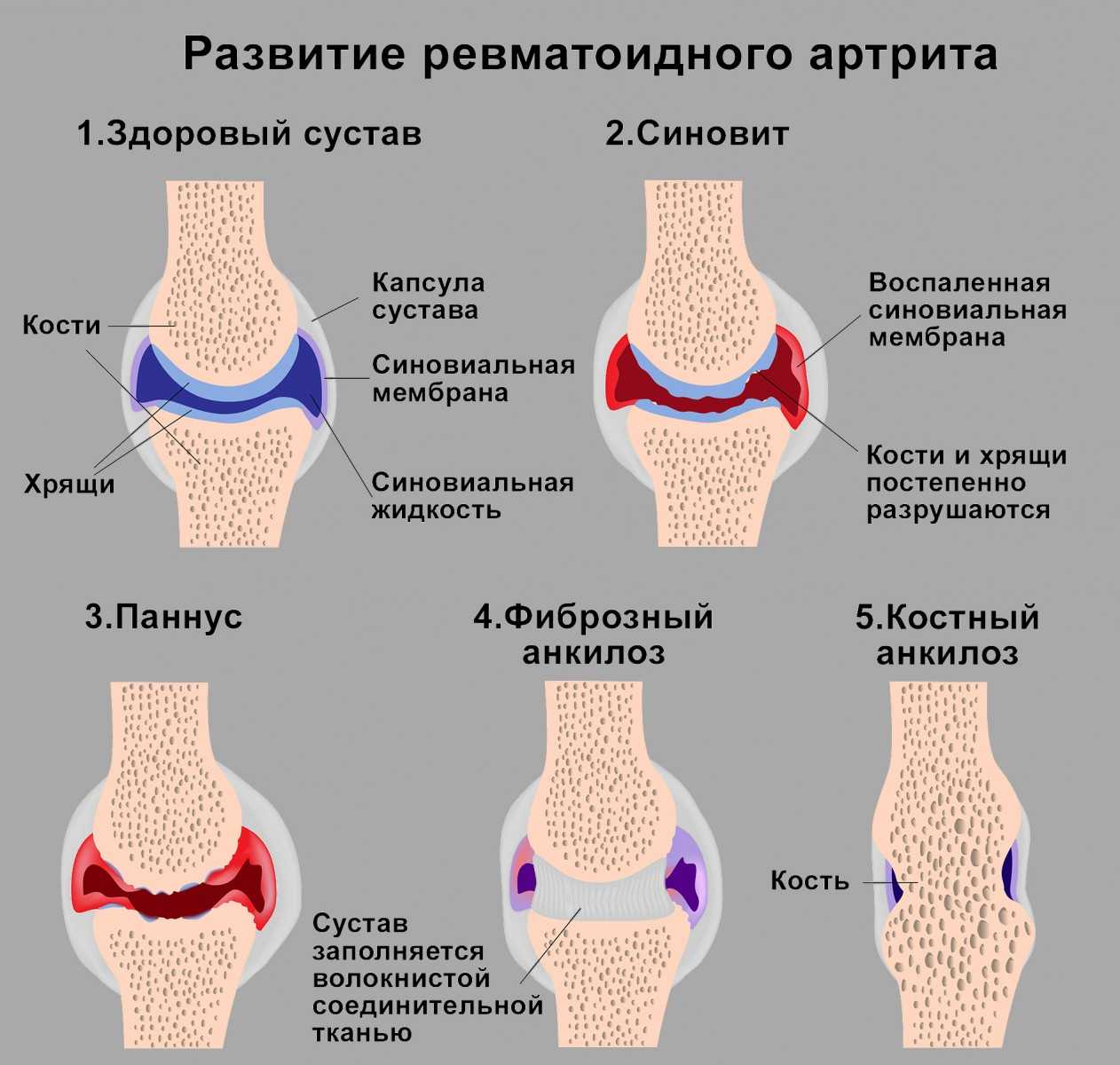 Артрит пальцев рук: симптомы и лечение, болят суставы пальцев рук, причины и лечение народными средствами, признаки, диета | ревматолог | zaslonovgrad.ru