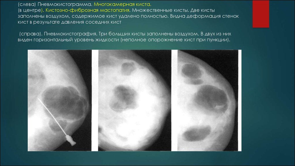 Подтяжка груди: отзывы пациенток