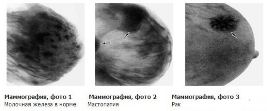Подтяжка груди - доктор вардан хачатрян