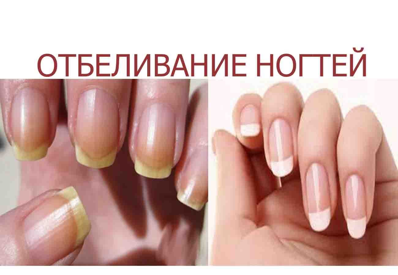 7 простых способов отбелить желтые ногти в домашних условиях