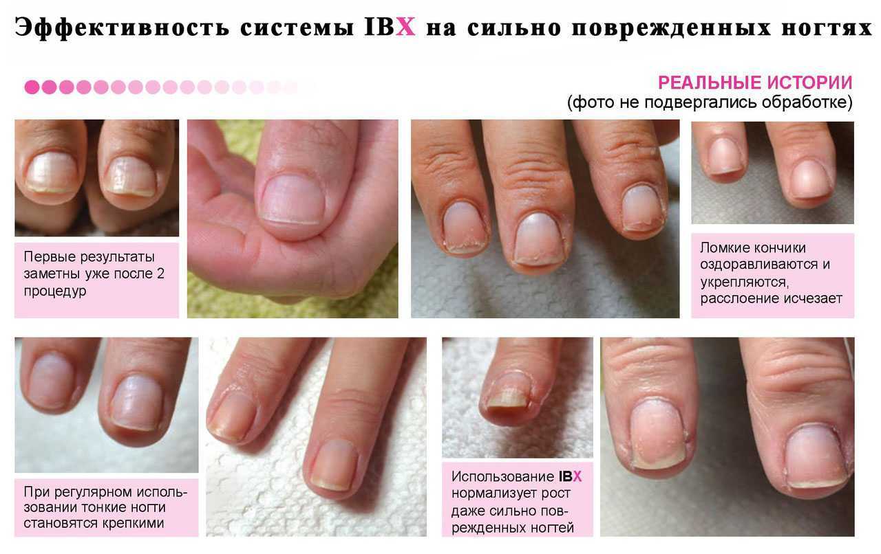 Восстановление ногтей после снятия гель-лака (шелака)