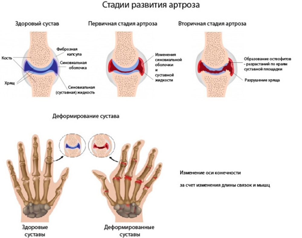 Лечение артрита суставов пальцев рук народными средствами в домашних условиях - твой суставчик