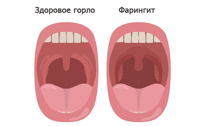 Лечение фарингита народными средствами у взрослых
лечение фарингита народными средствами у взрослых