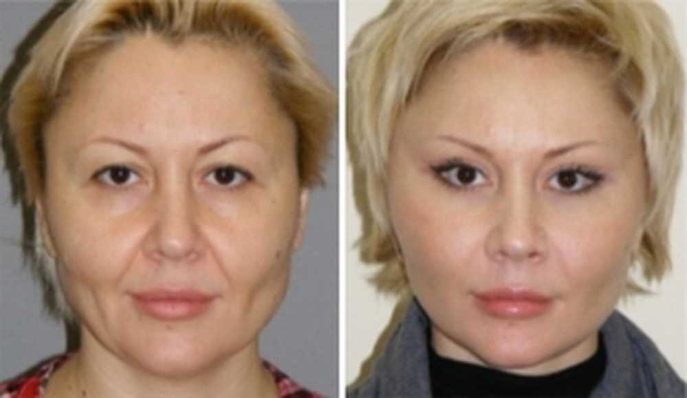 Какие пластические операции и процедуры красоты не стоит делать до 35 лет