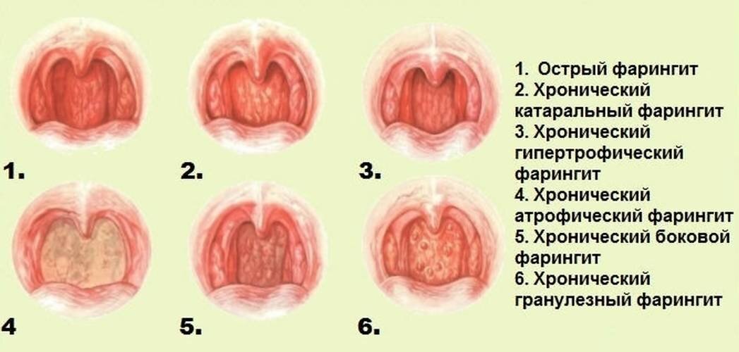 Фарингит: симптомы и лечение у взрослых в домашних условиях