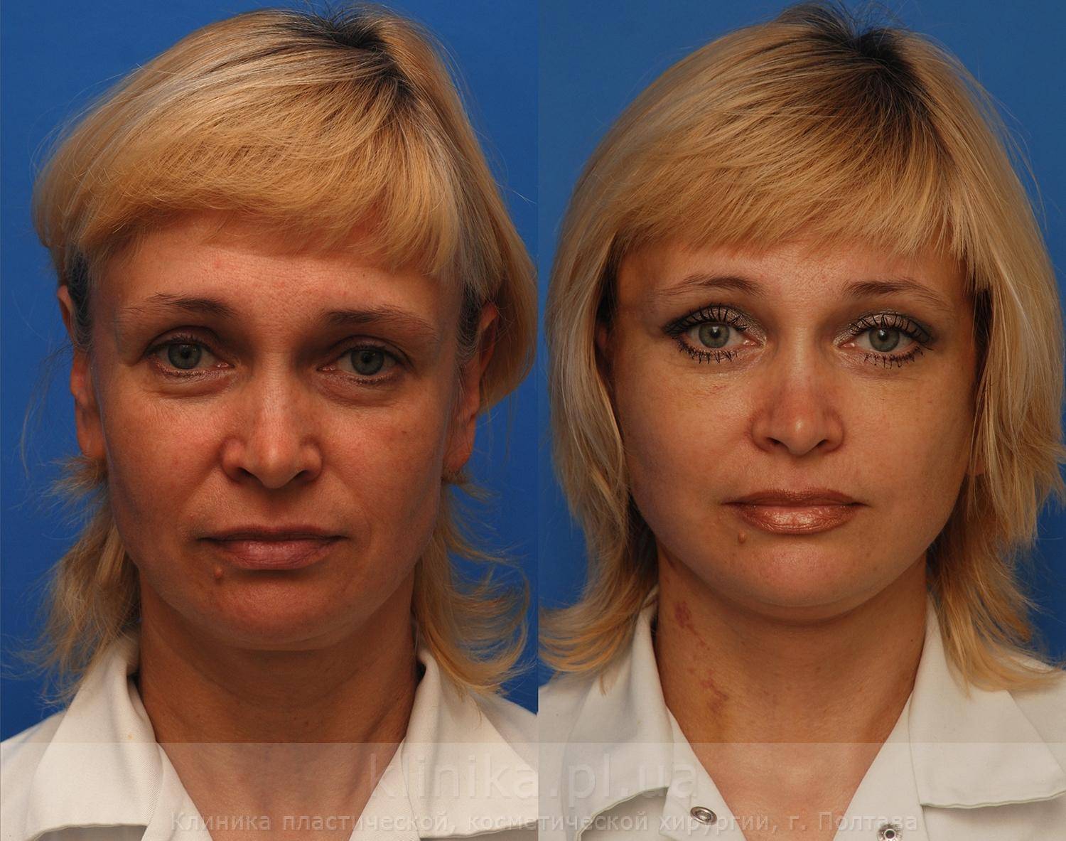 Нитевой лифтинг: мнение экспертов