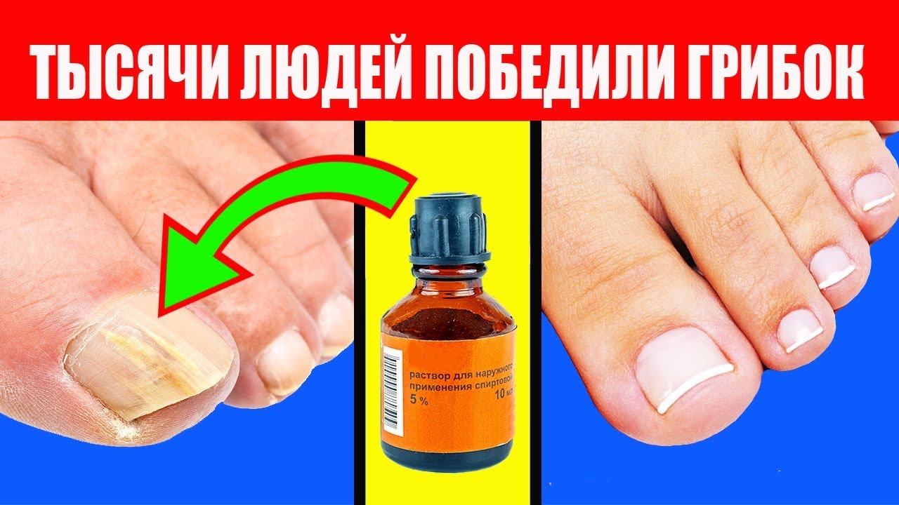 Народные средства от грибка ногтей на ногах: 7 быстрых и дешевых способов избавиться от грибка