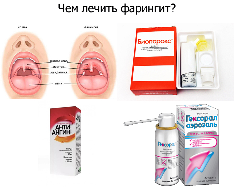 Ингаляции, полоскания и компрессы: лечение фарингита народными средствами -