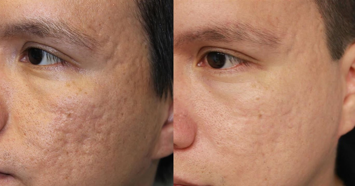 Журнал tatler лазер-революционер picosure с триумфом прибыл в клинику эстетической медицины lаrt
