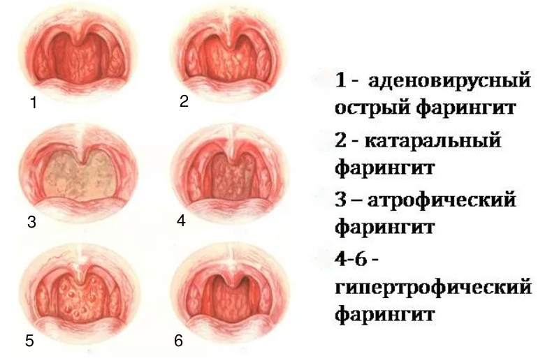 Лечение фарингита народными средствами самые эффективные | портал о народной медицине